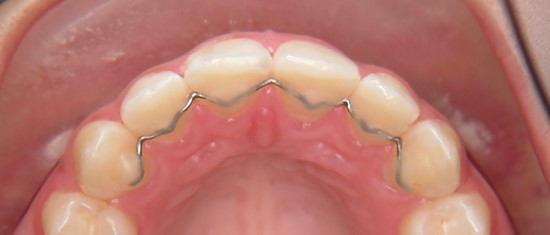 Fester Retainer auf der Innenseite der oberen Frontzähne