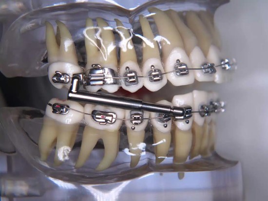 Bio-Bite-Corrector: Wenn es mit der Bisskorrektur mit Elastiks gar nicht klappt, leisten solche Zusatzgeräte gute Dienste